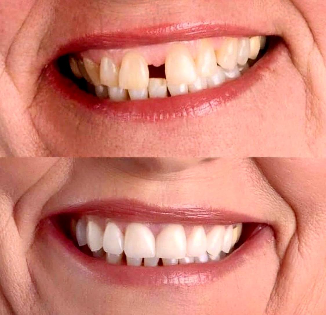 Antes do implante dentário sem dor na Dental Express