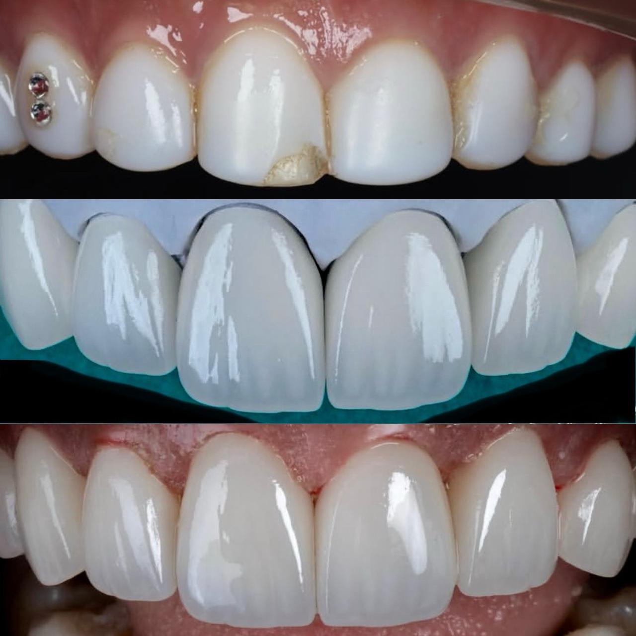 Sorriso após implante dentário sem dor - antes e depois