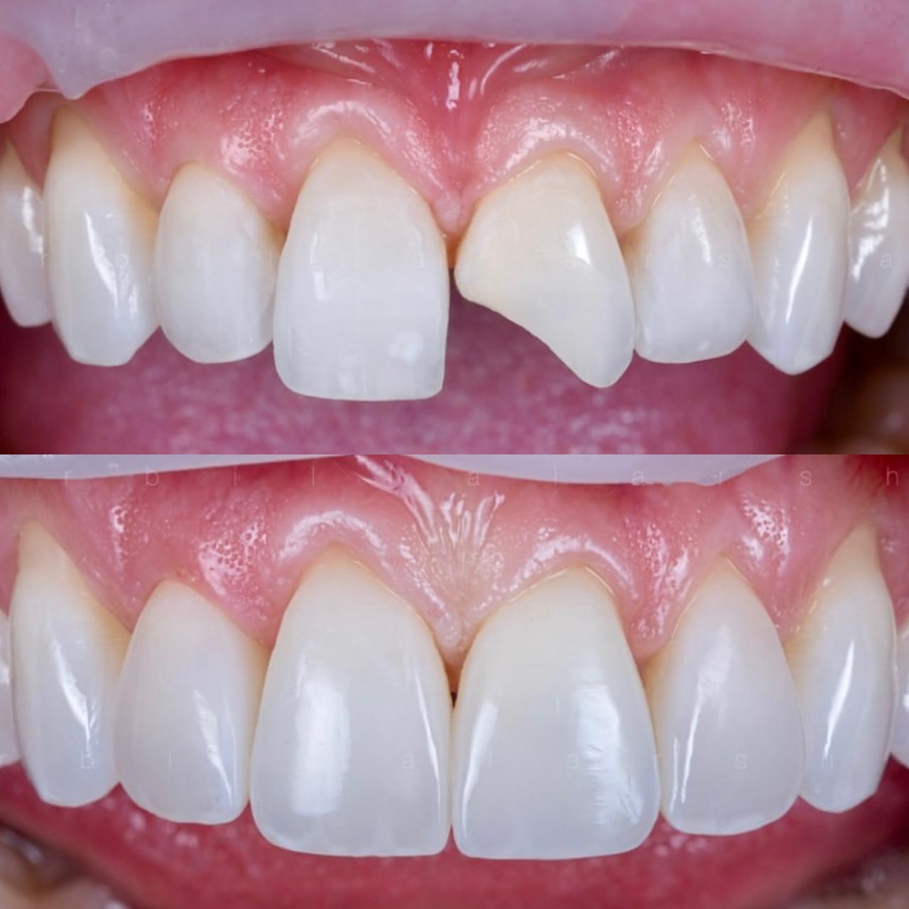 Resultado de implante dentário sem dor - Dental Express Implantes
