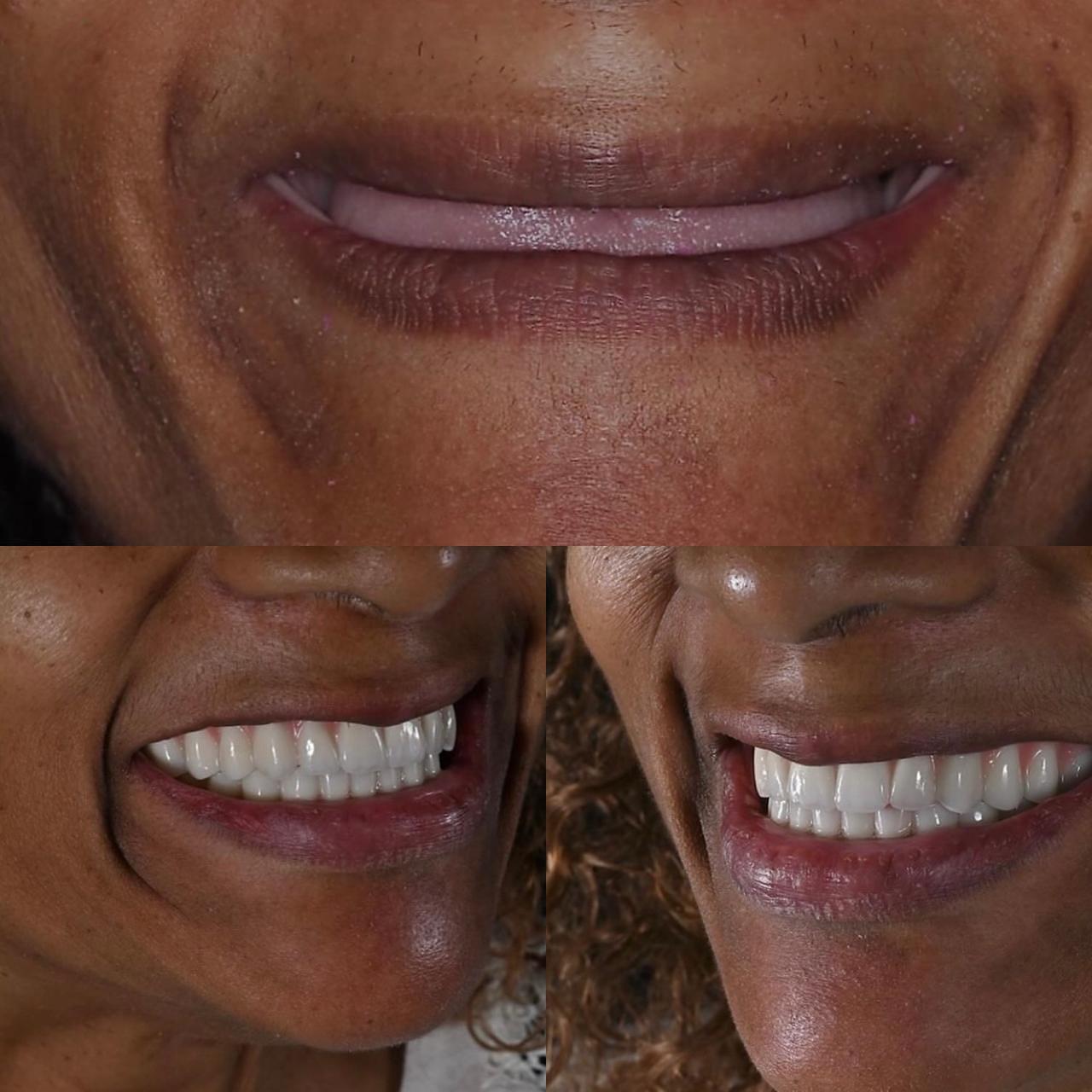 Paciente sorrindo após implante dentário sem dor